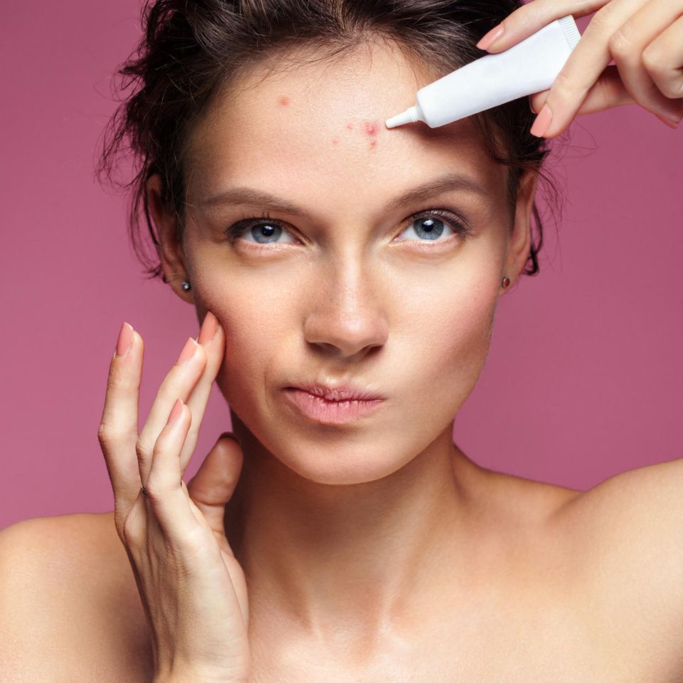 Removing pimples: young woman with pimples on her face, pimples on her forehead, fighting pimples with cream