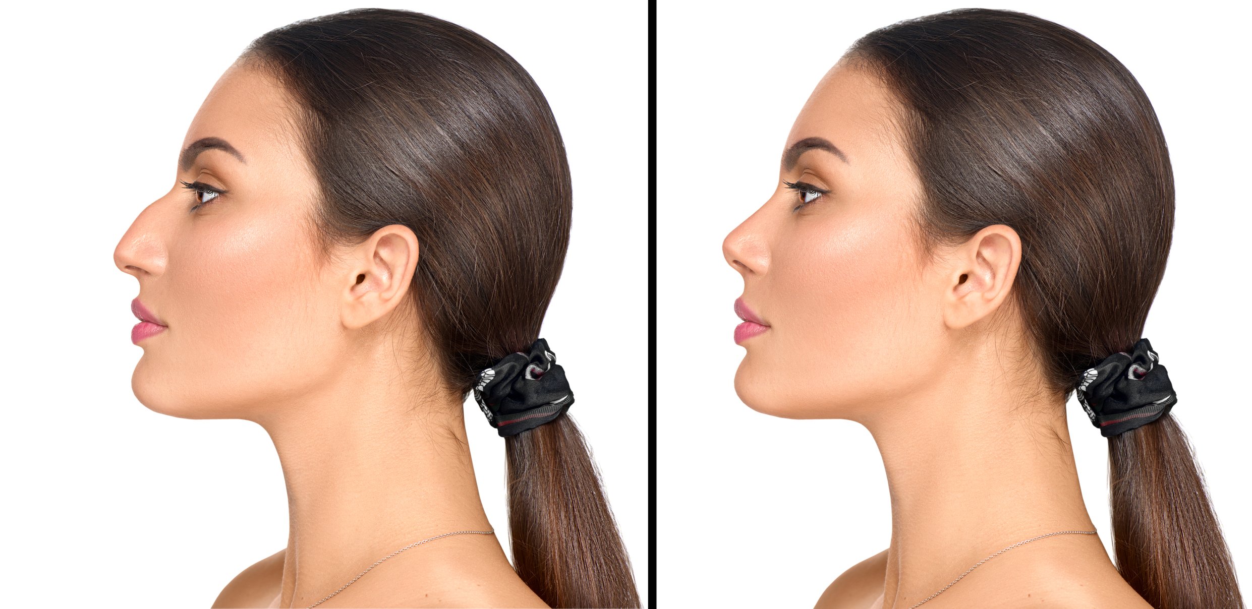 What You Need to Know Before Having Rhinoplasty in Turkey