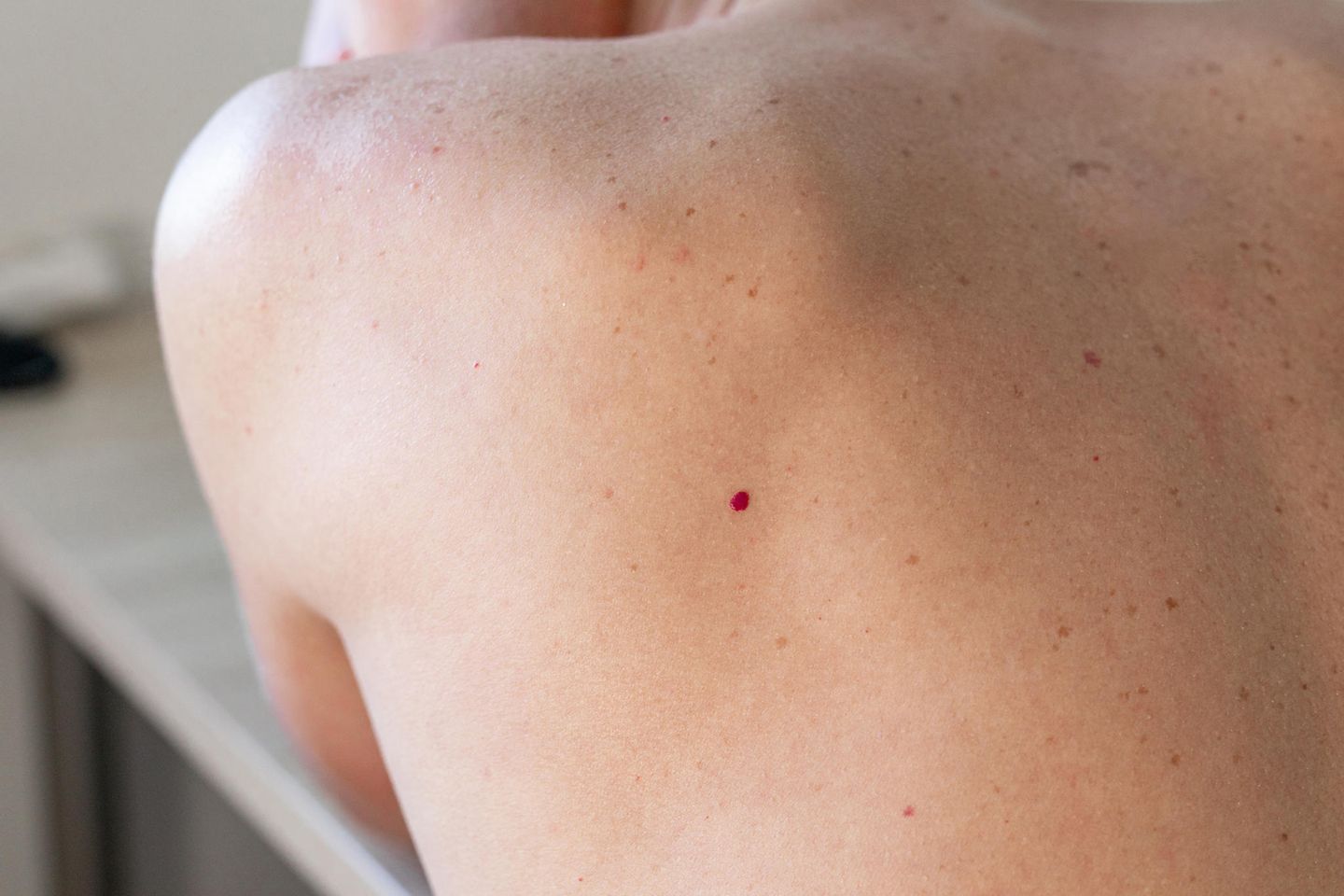 Ruby Spots: Woman with ruby ​​spot on her back